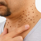 Warga di Jakarta, Papiloma Kering kalau Buang Parasit di Rumah!